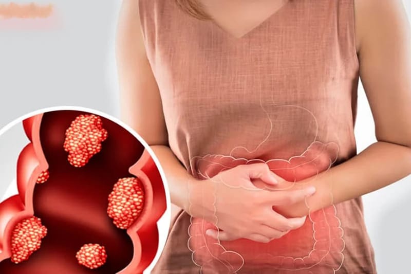 Hiểu hiện khi bị Polyp đại tràng cần nắm rõ để phát hiện kịp thời