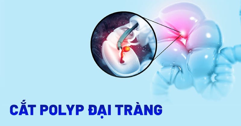 Cắt polyp đại tràng có mọc lại không và 2 cách điều trị Polyp thông dụng nhất