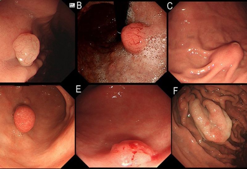 Polyp dạ dày là gì? Đây thường là các khối u lành tính