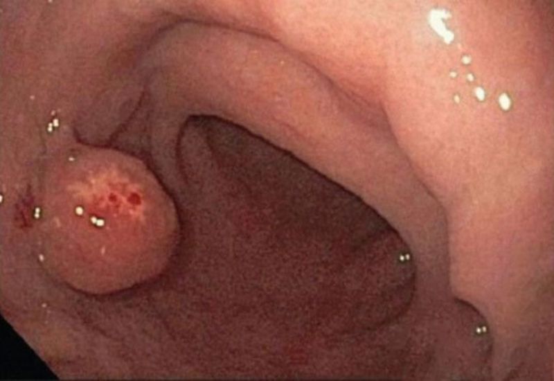 Polyp dạ dày là gì? Polyp tuyến đáy là loại thường gặp nhất