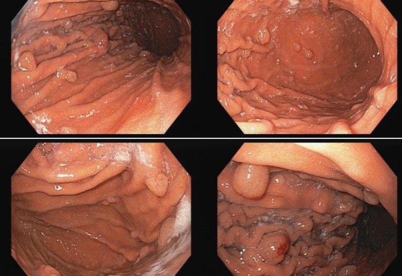 Có một số trường hợp cần phải thực hiện phẫu thuật cắt bỏ polyp