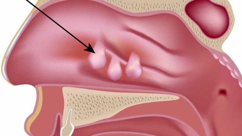 Polyp mũi là sự phát triển bất thường của lớp niêm mạc mũi và các xoang.