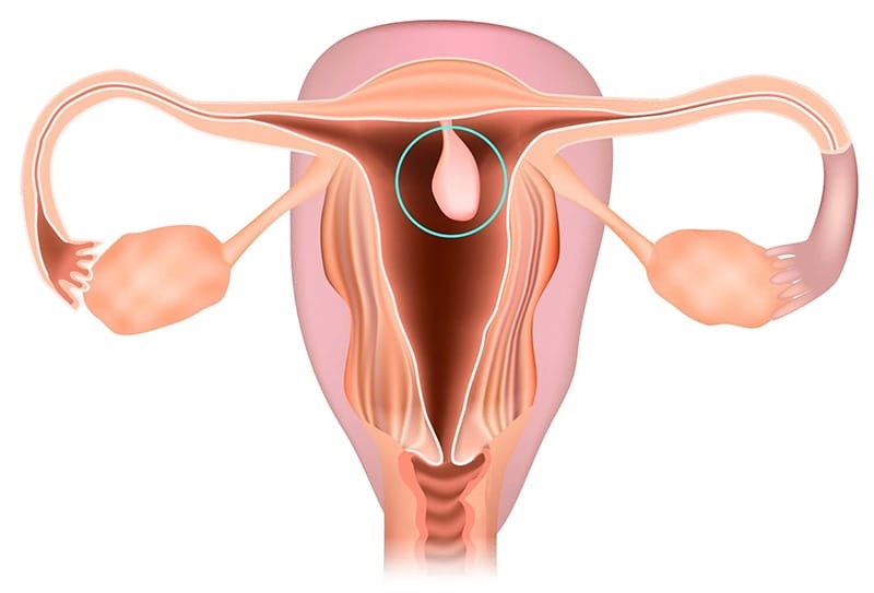 Polyp tử cung là hiện tượng lớp tuyến và mô đệm của nội mạc tử cung phát triển quá mức.