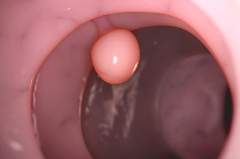 Polyp là gì? Thường có dạng u nhỏ, kích thước 1.5-2cm