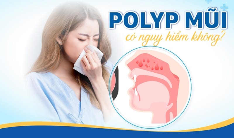 Polyp mũi có nguy hiểm không - góc giải đáp