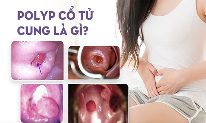 Polyp tử cung có chuyển phôi được không? có nguy hiểm không?