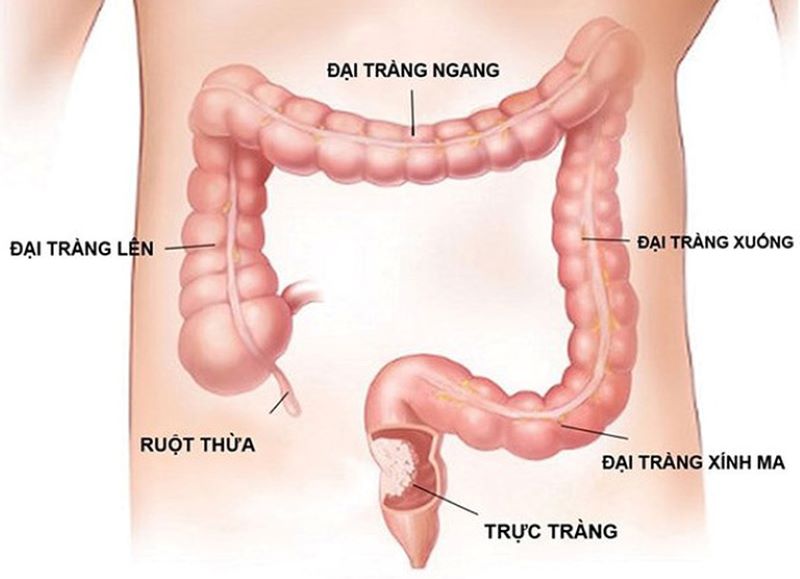 Polyp trực tràng là những khối u lồi nằm ở vị trí trực tràng gây ra cảm giác đau rát