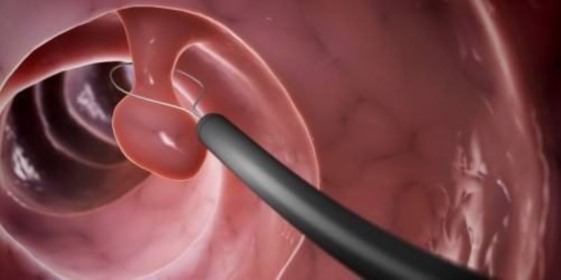 Nội soi trực tràng bằng phương pháp nội soi đại tràng sigma ống mềm là cách chẩn đoán polyp trực tràng ở trẻ em