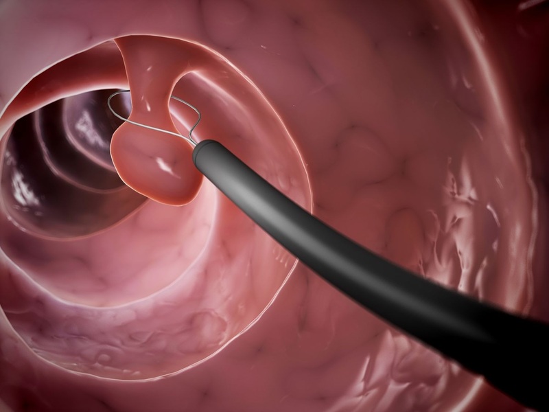 Tìm hiểu về polyp đại tràng trước để rõ hơn các triệu chứng sau khi cắt polyp đại tràng